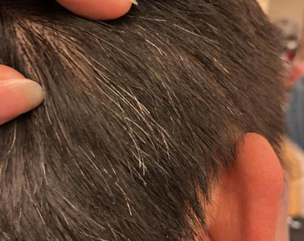 什么是營(yíng)養(yǎng)性灰白發(fā)？